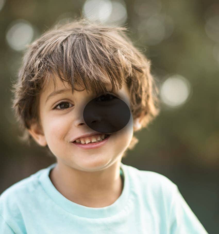 Degeneración Macular Relacionada a la Edad (Húmeda)